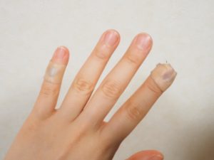 《噛まれた！》うさぎの噛み傷から感染する病気・症状